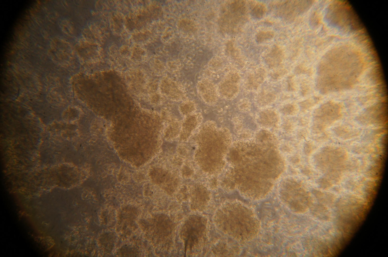 Rivelato il meccanismo di sopravvivenza delle cellule nella leucemia infantile