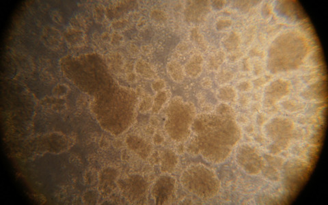 Rivelato il meccanismo di sopravvivenza delle cellule nella leucemia infantile